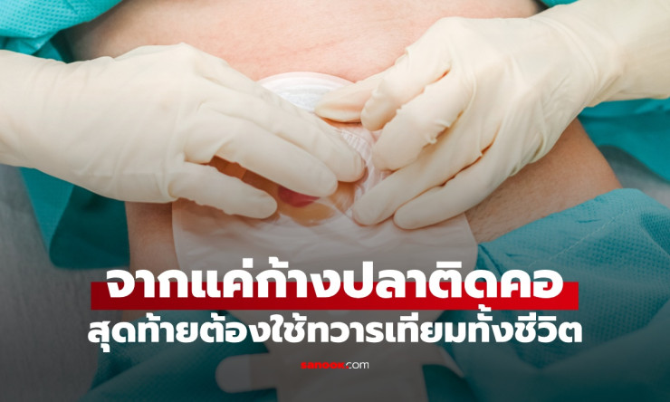 สยอง! ก้างปลาติดคอ กลืนข้าวดันลงท้อง สุดท้ายต้องทำ ทวารเทียม ใช้ชีวิตตลอดกาล อย่าหลงเชื่อโบราณอีกนะเ