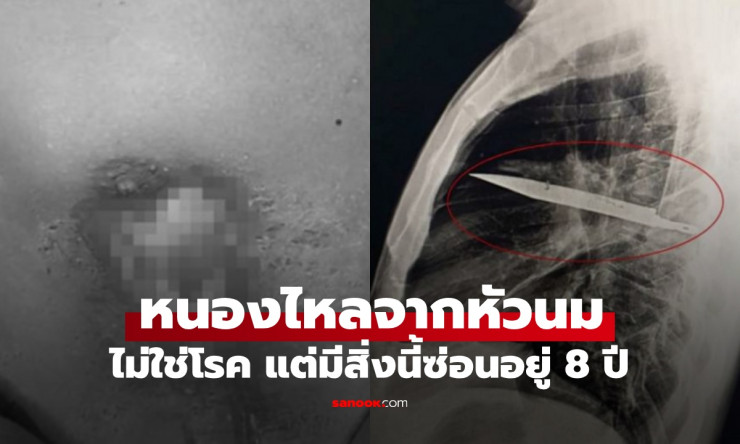 หมอตกตะลึง! คนไข้หนองไหลจากหัวนมขวา พบมีดเล่มเล็กซ่อนในร่างกายถึง 8 ปี