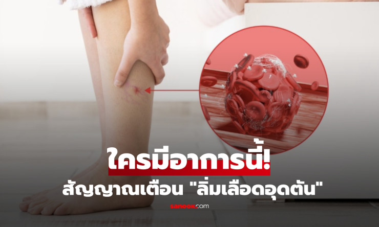 ขาบวมข้างเดียวอย่าชะล่าใจ! 4 สัญญาณเตือน DVT ลิ่มเลือดอุดตันที่ผู้หญิงและผู้ชายต้องรู้