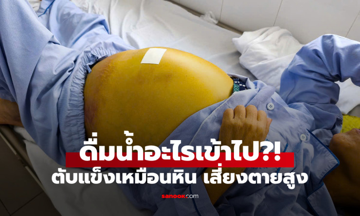 ไม่ใช่เหล้า หญิงนอนตัวเหลือง ตับแข็งเหมือนหิน เซ่นน้ำที่ดื่มเข้าไป แพทย์ชี้เสี่ยงตายสูง