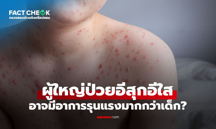 เช็กให้ชัวร์! ผู้ใหญ่เป็นอีสุกอีใส อาการหนักกว่าเด็กจริงไหม กรมควบคุมโรคตอบชัด