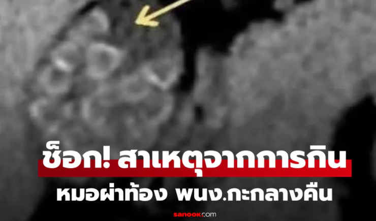 ผ่าท้องหญิง พนักงานกะดึก แพทย์สะพรึง เหมือนเปิดกล่องสุ่มคริสตัล ขนลุกสาเหตุจากการกิน!!!