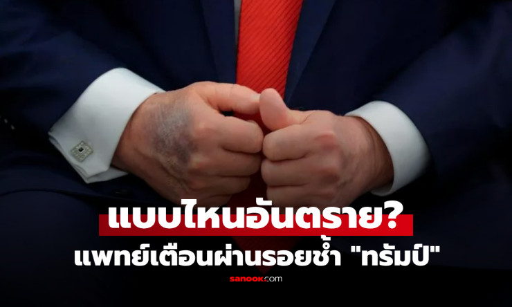 รอยช้ำแบบไหนอันตรายถึงชีวิต แพทย์เตือนผ่านเคสทรัมป์ เส้นเลือดดำบกพร่องเรื้อรังที่ไม่ควรมองข้าม