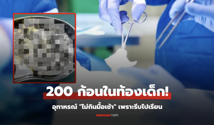 ลูกสาว 10 ขวบ ไม่กินมื้อเช้า พ่อแม่ช็อก ผ่าสิ่งนี้จากท้อง 200 ก้อน แพทย์ยังตกใจทั้งทีม!