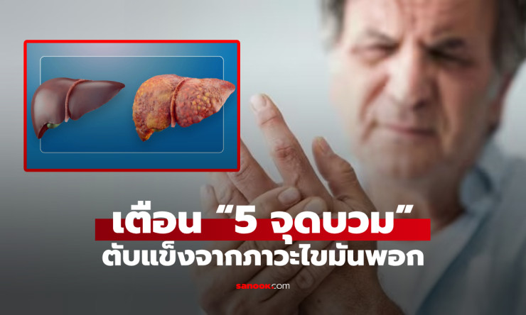 เมื่อไขมันบุกรุกทำลายตับ ร่างกายบวม 5 จุด เตือนมีแค่ 1 จุด ก็ควรรีบพบแพทย์!