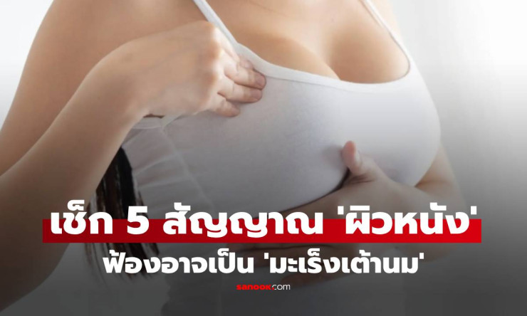 แพทย์เตือน! 5 สัญญาณผิวหนังฟ้อง มะเร็งเต้านม แม้คลำไม่เจอก้อน อย่าละเลย!