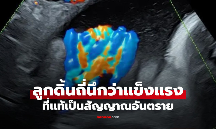ระทึก! แม่ท้อง 37 สัปดาห์ ลูกดิ้นแรงทั้งคืน นึกว่าแข็งแรง ก่อนอัลตราซาวด์พบสายสะดือพันตัว 5 รอบ