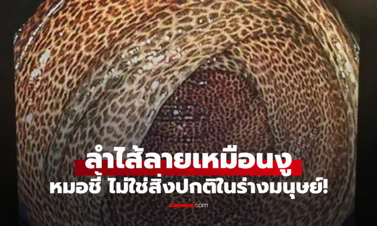 ไม่ใช่หนังงู แต่คือลำไส้มนุษย์! ดื่มทุกวัน เสี่ยงโรคร้ายที่คุณอาจไม่รู้