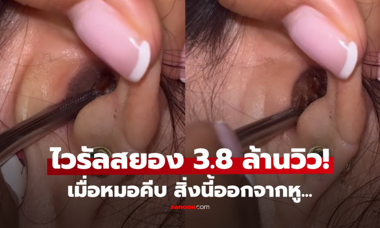 ขนลุกสุดขีด! ปวดหูเรื้อรัง คิดว่าแค่ขี้หูตัน หมอคีบออกมา... แมลงสาบตัวโต! เจ้าตัวยังร้องไห้กลัว