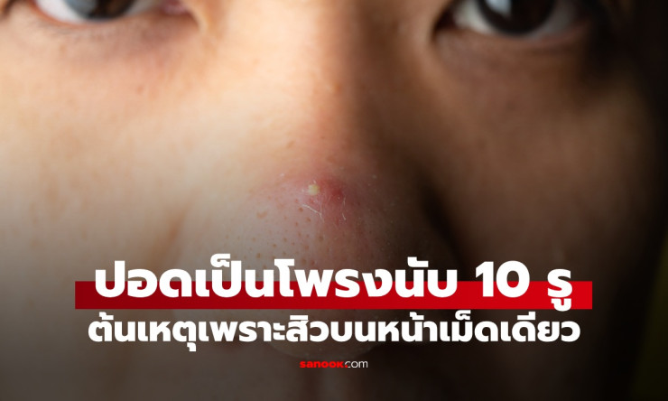 หนุ่มปอดมีโพรงกว่า 10 รู! เชื่อว่าเกิดจากสิวเม็ดเดียว ความจริงเบื้องหลังโรคปอดที่อันตรายถึงชีวิต