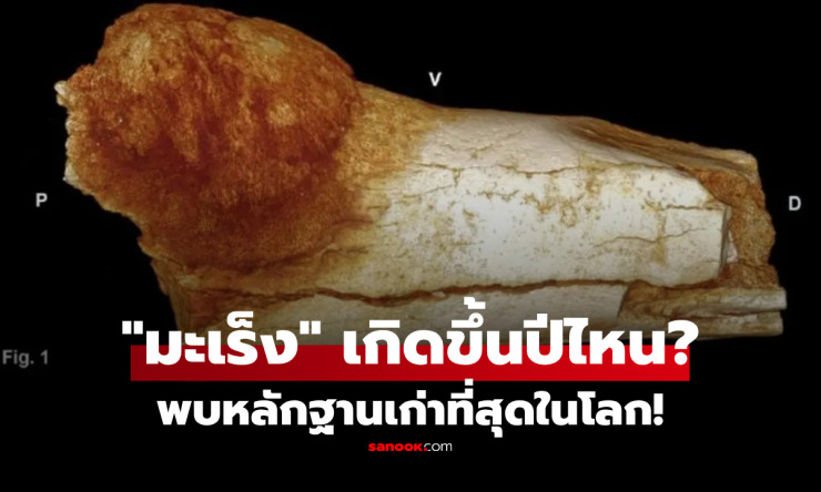 เปิดหลักฐานช็อกโลก! มะเร็งไม่ใช่โรคยุคใหม่ พบในฟอสซิลญาติมนุษย์อายุ 1.7 ล้านปี